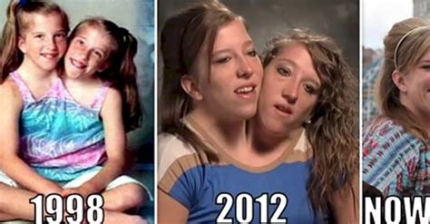 conjoined twins porn|Conjoined Twins Xxx Porn Videos .